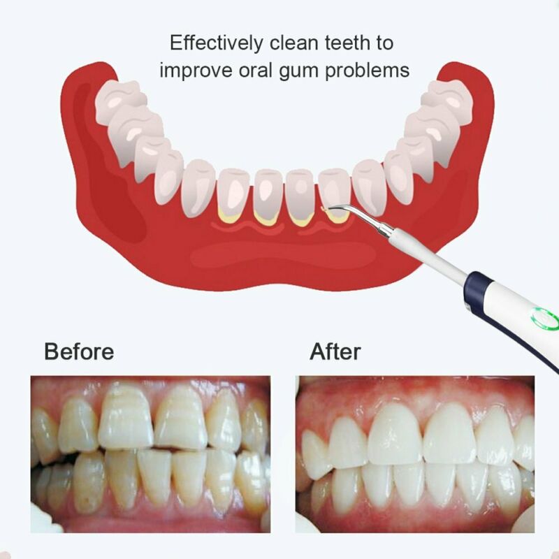 5in1 Tooth Polishing Cleaner Ultrasonic LED Electric Oral Teeth Cleaning Kit